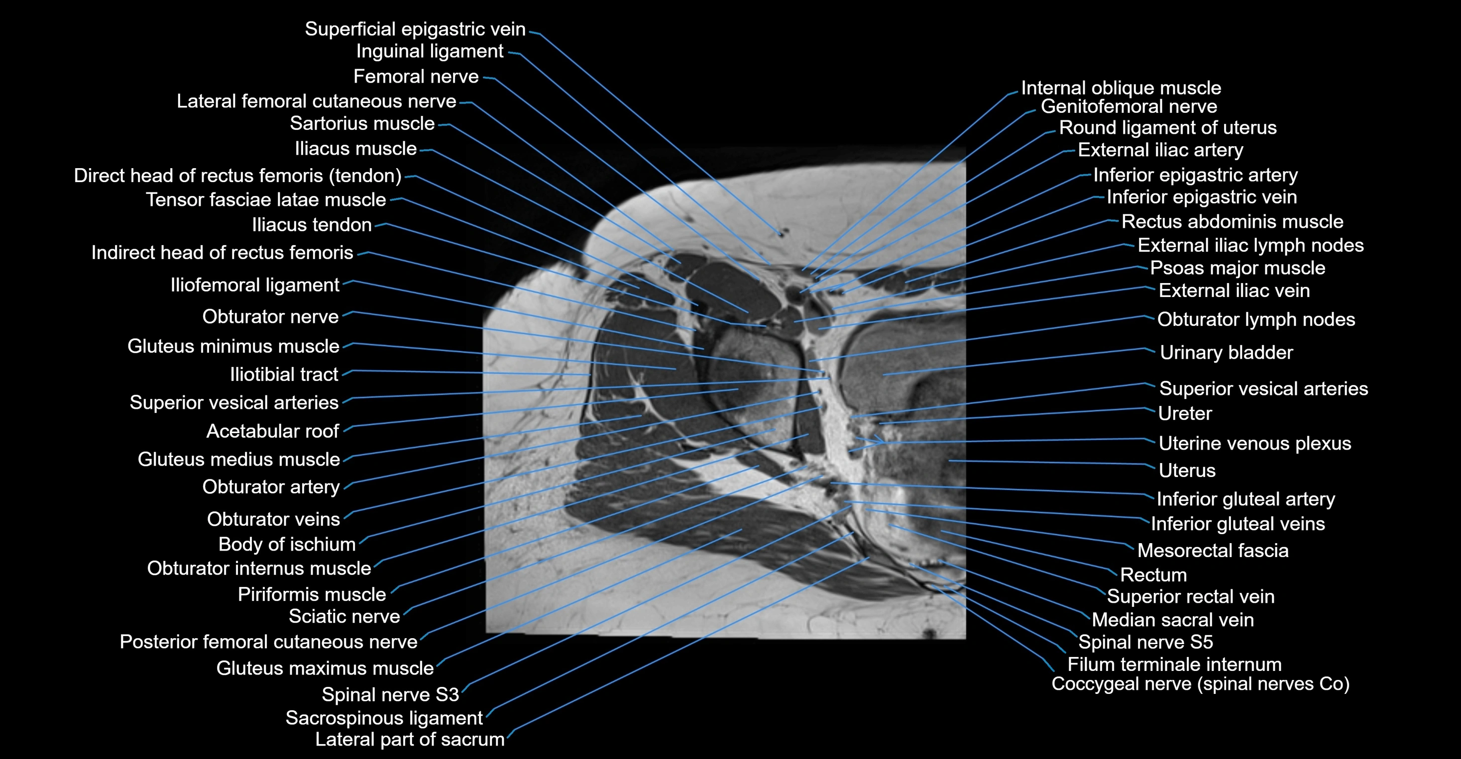 MRI hip axial cross sectional anatomy 3T 3D  radiology  anatomy image-img-00001-00026.webp